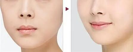 隆鼻后多久恢复_隆鼻多久可以恢复到最佳状态