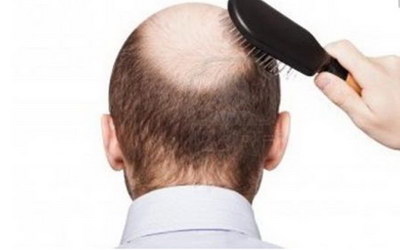引起脂溢性脱发的原因有哪些【脂溢性脱发是什么原因引起的】