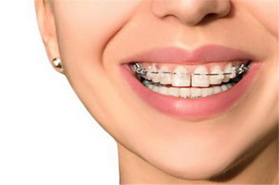 牙齿严重畸形矫正要多久_牙齿严重畸形矫正过程