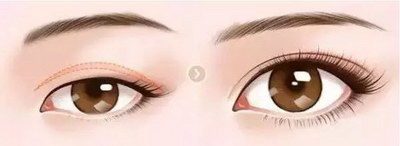 双眼皮有几种类_双眼皮是如何形成的分为几种类型